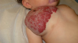 Angioma infantile