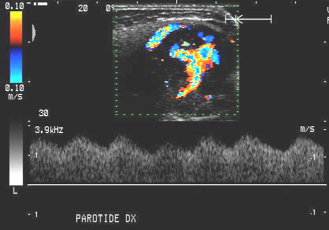 Eco Doppler