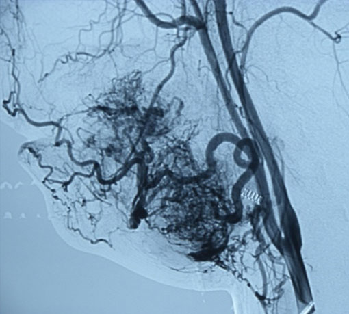 Angiografia