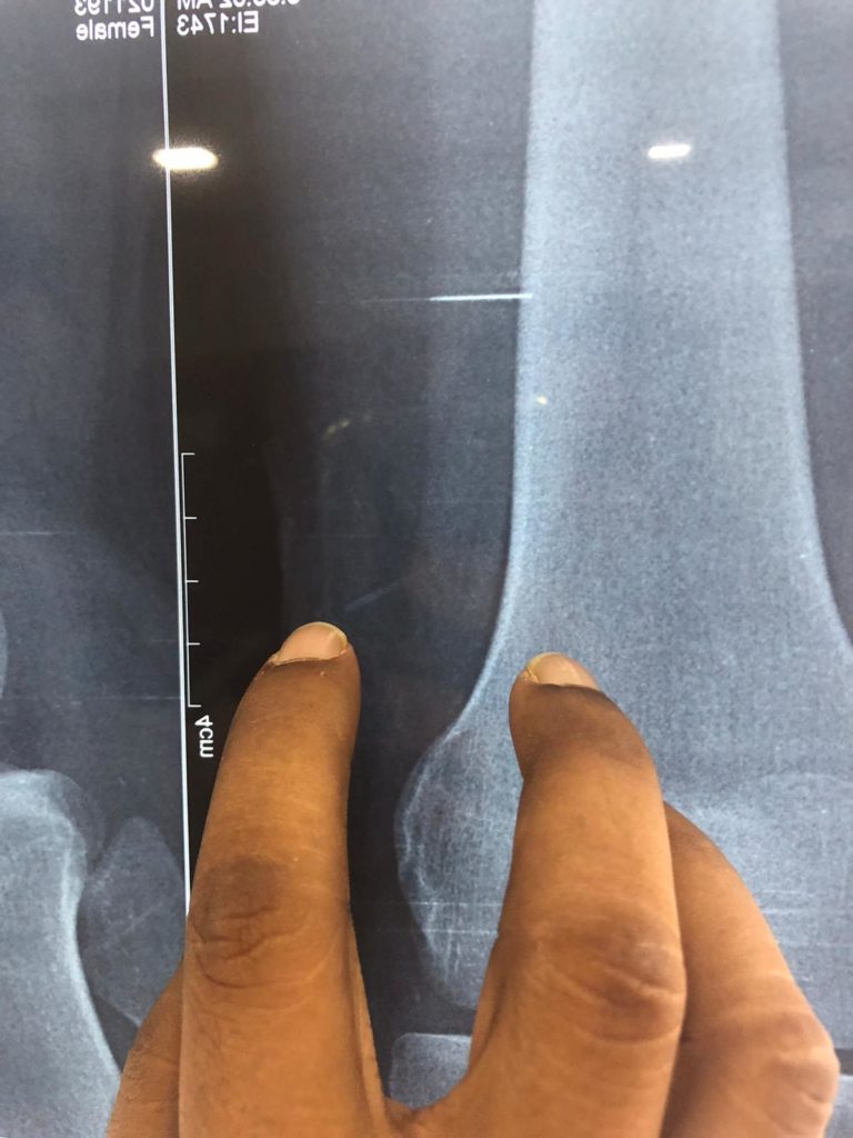 La spina nella radiografia "indiana" con le dita del chirurgo locale.