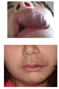 Laser intralesionale