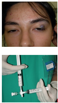 Scleroterapia