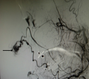 Embolizzazione di MAV circoscritta al volt