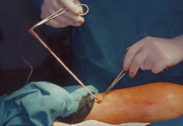 Vena marginale asportata