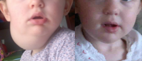 Linfangioma al collo - asportazione