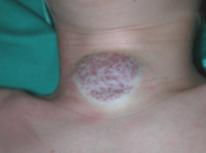 NICH (Non Involuting Congenital Hemangioma) / Emangioma non involutivo