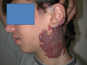 NICH (Non Involuting Congenital Hemangioma) / Emangioma non involutivo