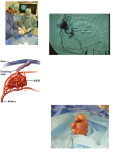 Embolizzazione