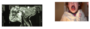 Malformazioni linfatiche microcistiche /Linfangiomi microcistici