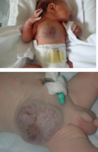 RICH/ Rapidly Involuting Congenital Hemangioma