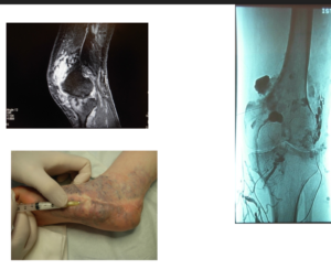 Sclero-embolizzazione