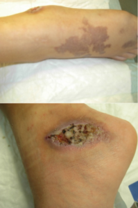 Sindrome di Stewart-Bluefarb (SBS) / Pseudokaposi Sarcoma (PKS)/acroangiodermatite