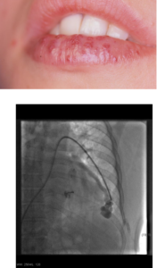 Sindrome di Osler-Weber-Rendu (OWR) /Teleangectasia Emorragica Ereditaria (HHT)