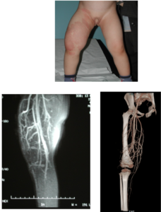 Sindrome di Parkes Weber (PKWS)